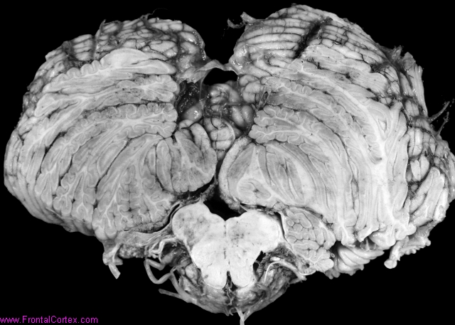 Dorsal medullary infarct without cerebellar infarction